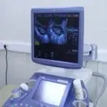 СПКЯ (PCOS) – ці симптоми типові для синдрому